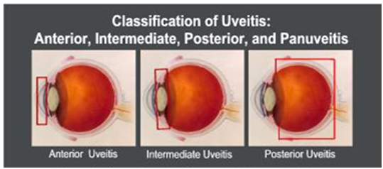 Anterior-Uveitis