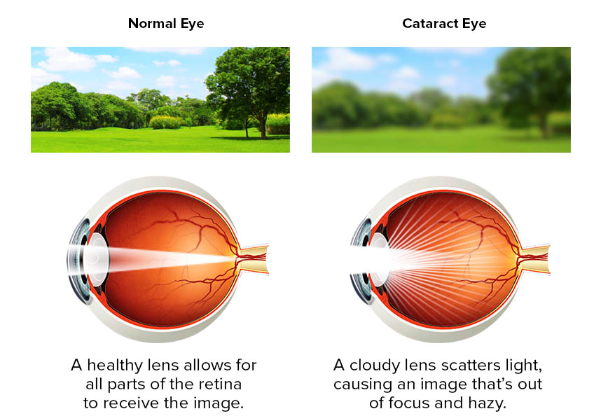 Normal-eye