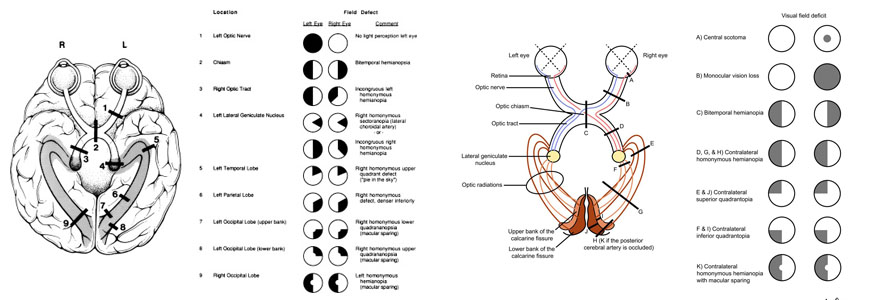 Cataract