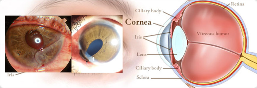 Cataract